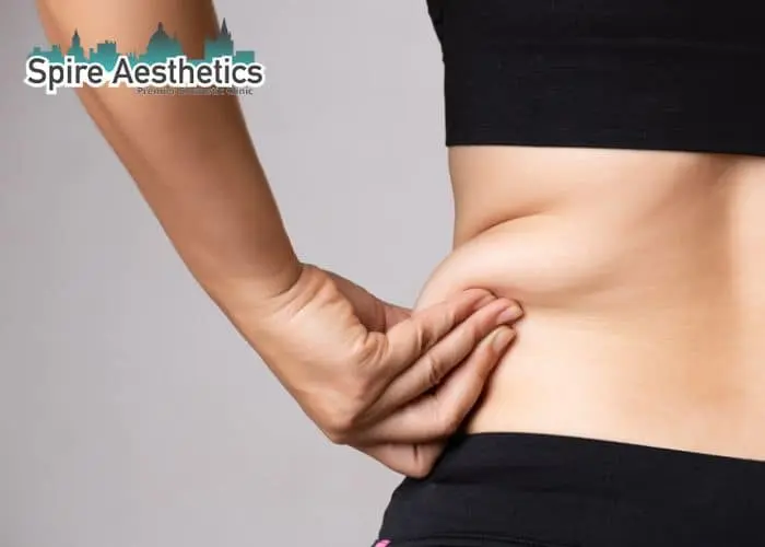 Image of woman pinching fat on their hips Broxburn. Fat Freezing treatment