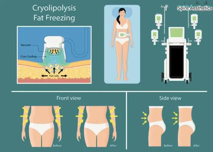 Fat freezing treatment Broxburn benefits for competitions to remove stubborn fat deposits.