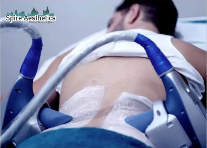 Man having fat freezing treatment done on love handles before a competitions Broxburn to create a sculpted look.