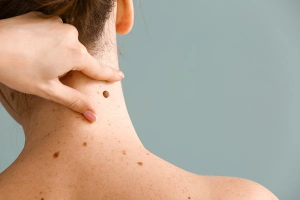 Prices and promotions for blemish removal Broxburn contact our team today!