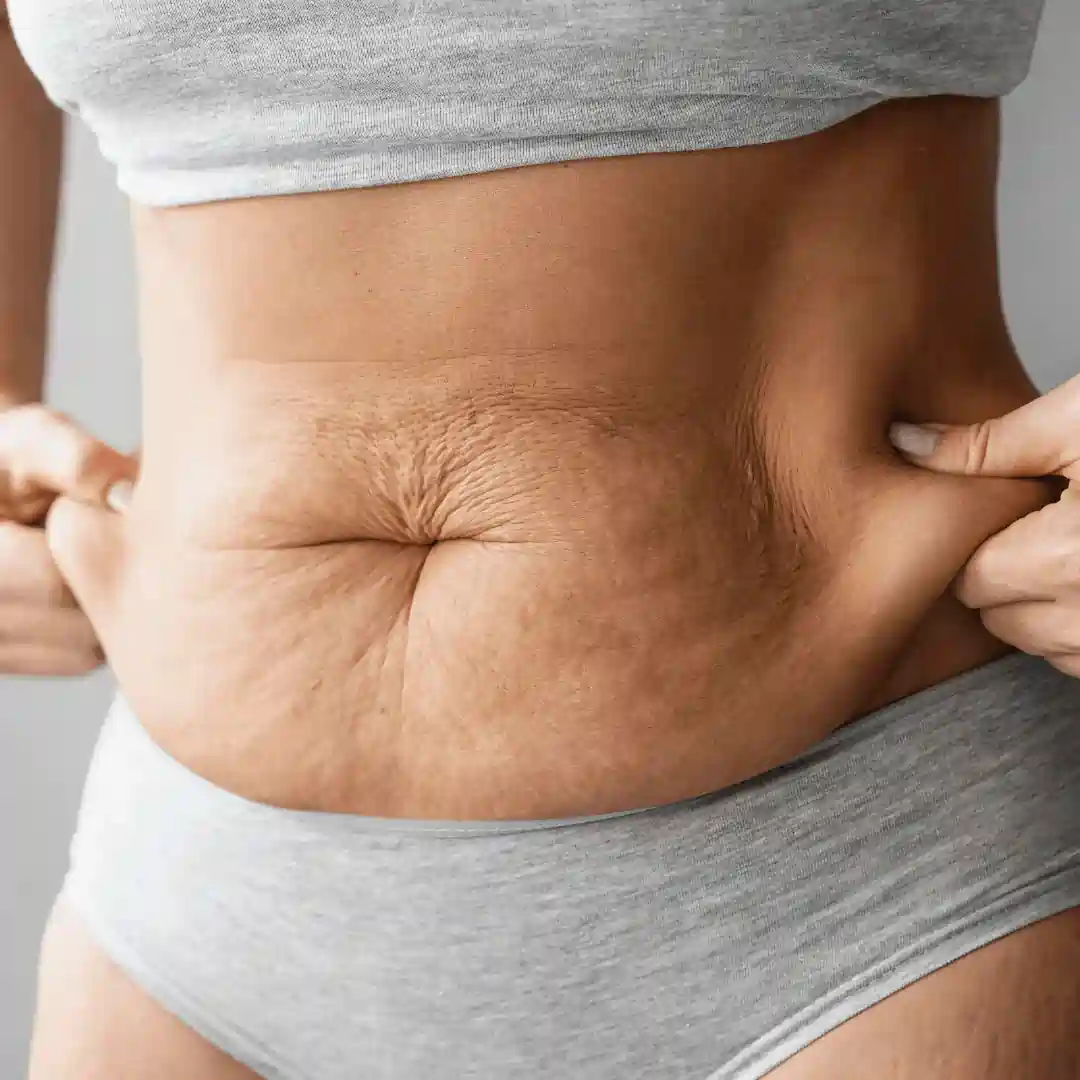 Is It Normal to Have Loose Skin After Pregnancy Broxburn?